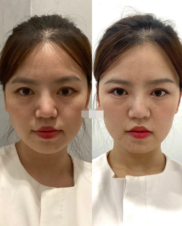 热玛吉前后效果对比图差别大吗,热玛吉副作用多吗