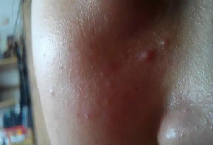 手臂脂肪粒图片