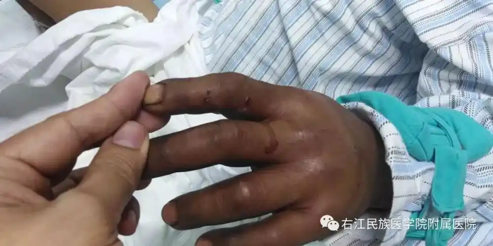 丘北县一男子被眼镜王蛇咬伤心跳停止 百色医护人员跨省救援