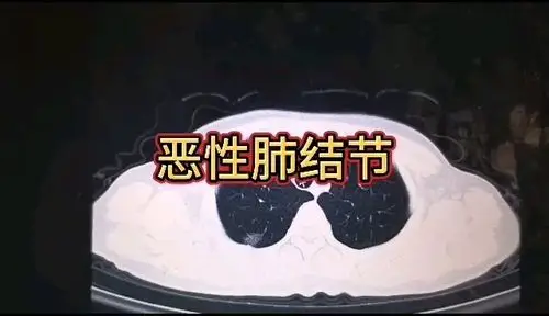 谢谢网友提供的图像资料,让我们看看这一例恶性肺结节有哪些征象?