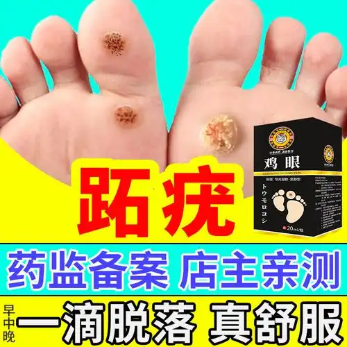 跖疣膏去除足部趾疣病毒疣脚底手部肉刺拓根疣药膏寻常疣醋酸专用