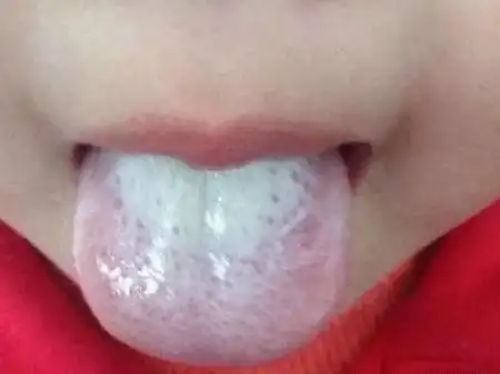 宝宝舌苔白厚是什么问题,可以刮掉吗