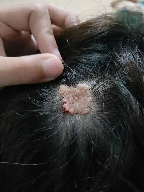 你好,我一个好姐妹头顶上这东西叫什么 有得治吗?请看相片.