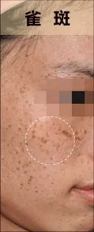 雀斑