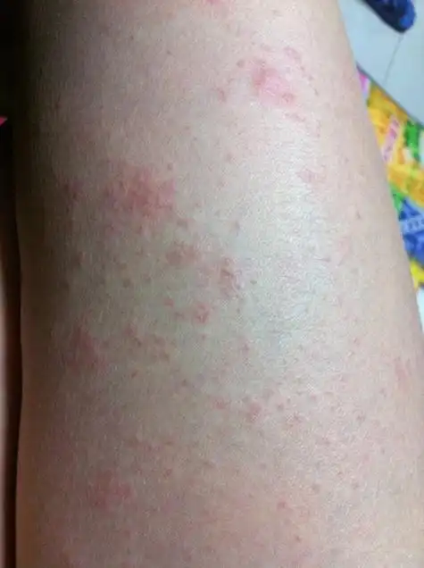 大人湿疹症状图片_有来医生