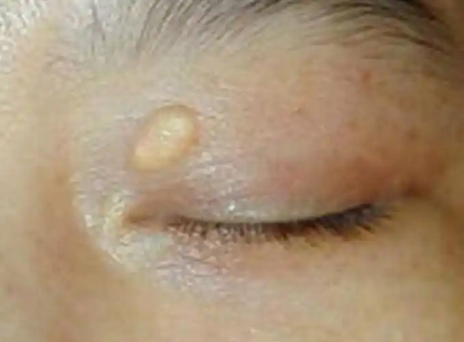 足部黄色瘤病图片