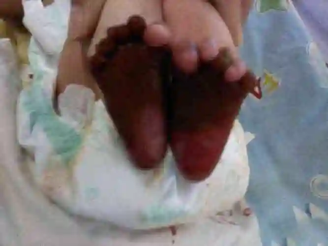 火烧火棉胶婴儿图片