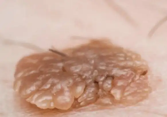 男性尖锐早期症状图片6