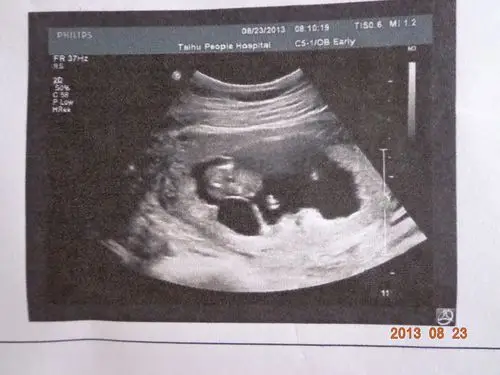 向羊膜腔内突起的囊性回声是什么?