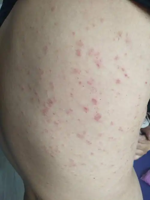 全身红疹,你要了解这些!