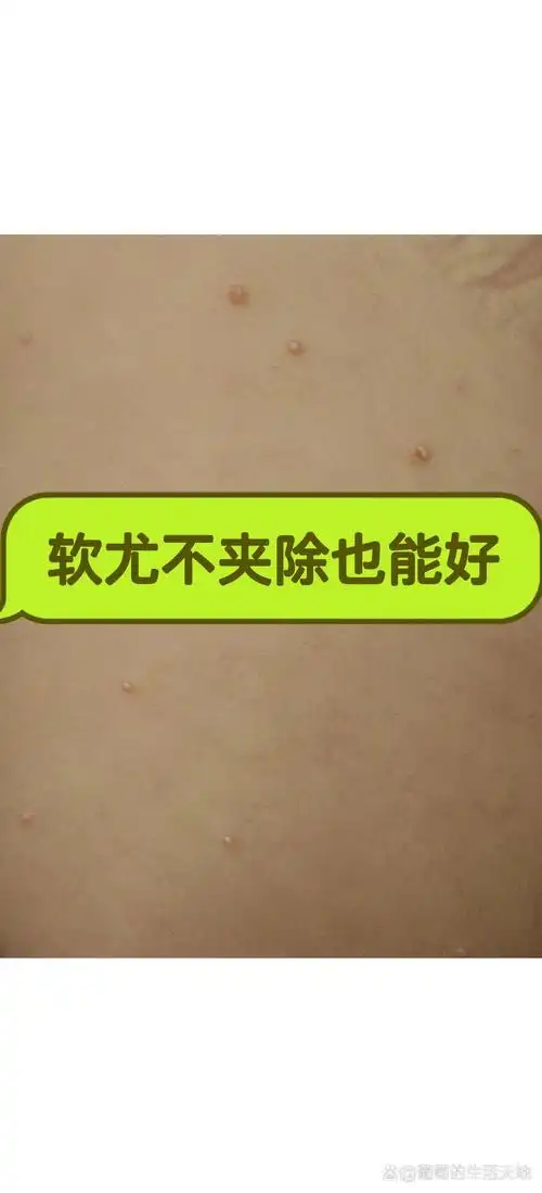 软疣只能夹除冷冻吗?