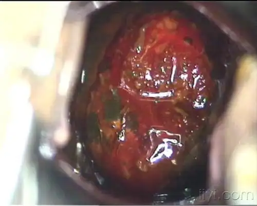 慢性宫颈炎的诊断与治疗