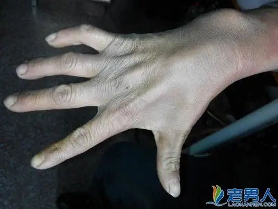 肌肉萎缩症是怎么引起的 症状及疗法有哪些 / 比乐族