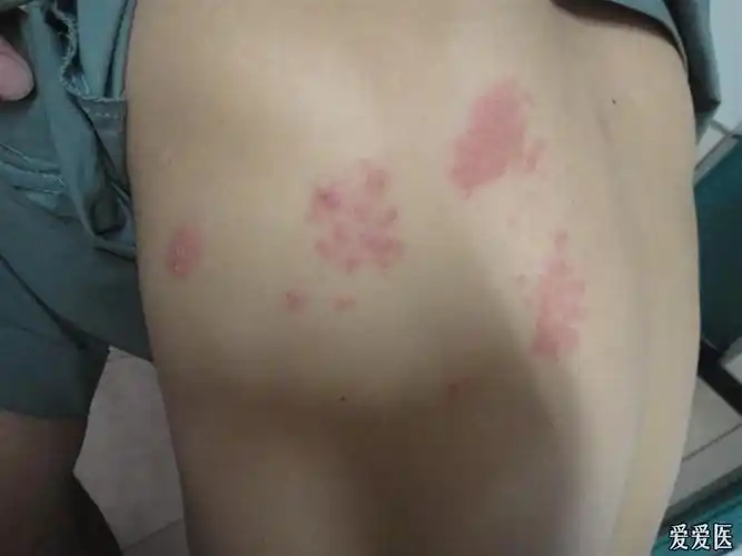 背部皮疹