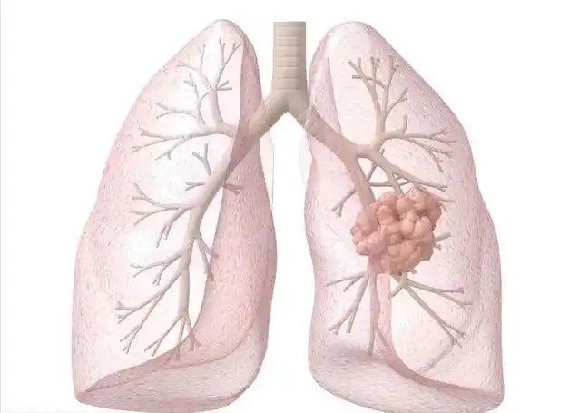 在该病基础上,可能并发肺结核和肺癌,因此尘肺合并肺癌的概率高