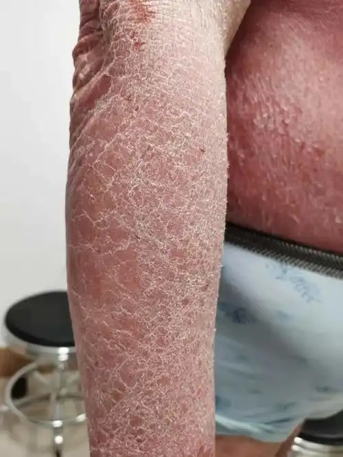 钱看没了家也散了都因这个掉鳞又掉屑的病