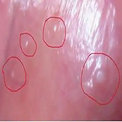 大同龟头炎医院_大同治疗龟头炎哪家医院好_大同治疗龟头炎权威的医院