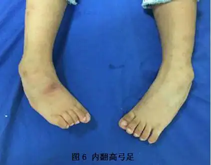 发现脊髓栓系,应该怎么办?(转自我的老师-尚爱加) (转载)