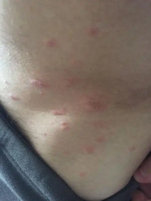 一开始皮肤长了几个癣,擦了点药,然后开始起红色的点点,现在越来越多