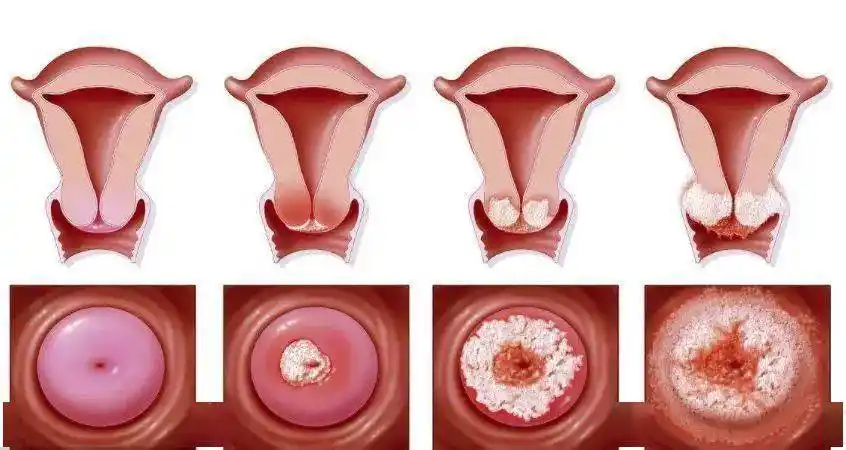 大量研究数据表明,持续性感染高危hpv是诱发宫颈癌的主要因素,其中hpv