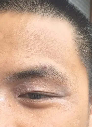 上眼睑皮肤脱皮