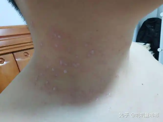 丝状疣脖子上女性医生说要激光扫有别的办法吗