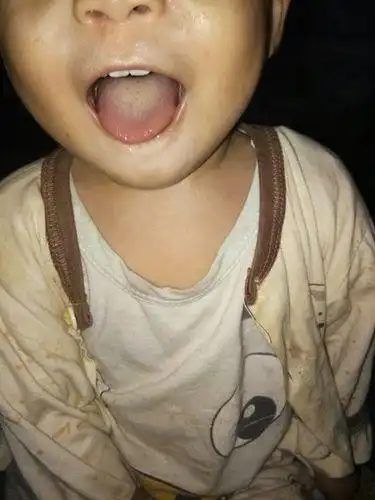 宝宝舌苔厚白怎么解决(宝宝舌苔厚白怎么办)