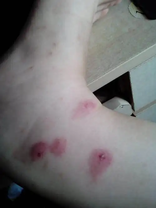 您好,我上周末经过草地,然后腿上被虫子叮咬了几个