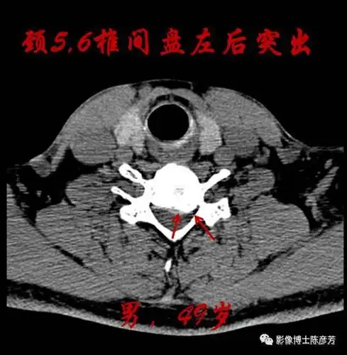 颈椎曲度消失了,怎么回事?