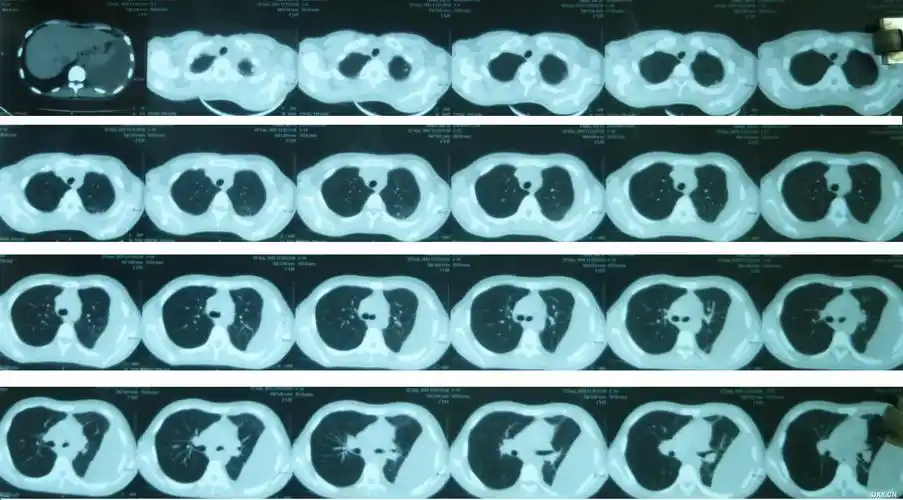 【病例讨论】女大学生胸腔积液待查,请各位大侠发表高论 [病例帖]