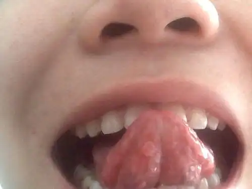 舌头背面长个包