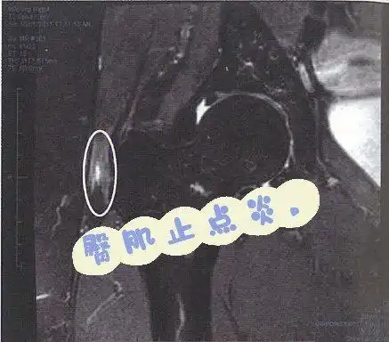 臀肌止点炎大转子滑囊炎哦no