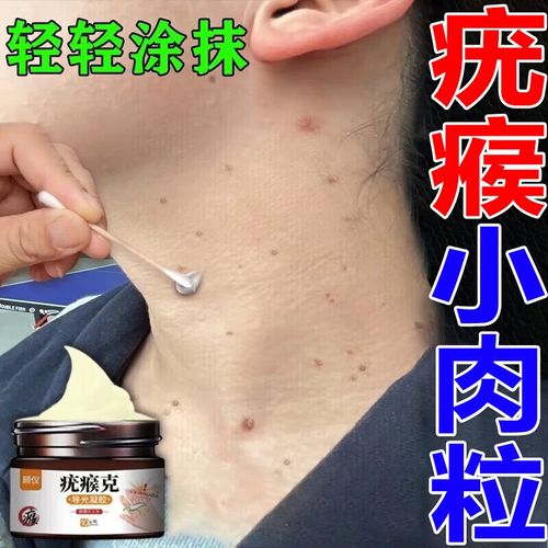 祛疣灵 肉粒扁平疣专用膏面部脖子祛扁平疣搭去除膏脖子上长小肉粒