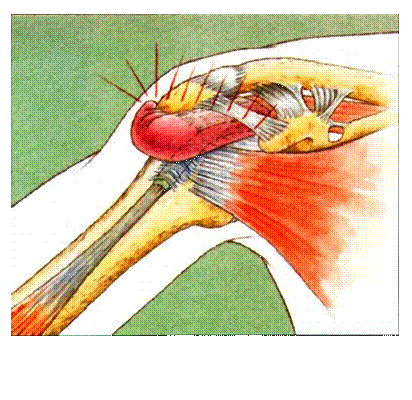 【科普】肱二头肌长头肌腱炎