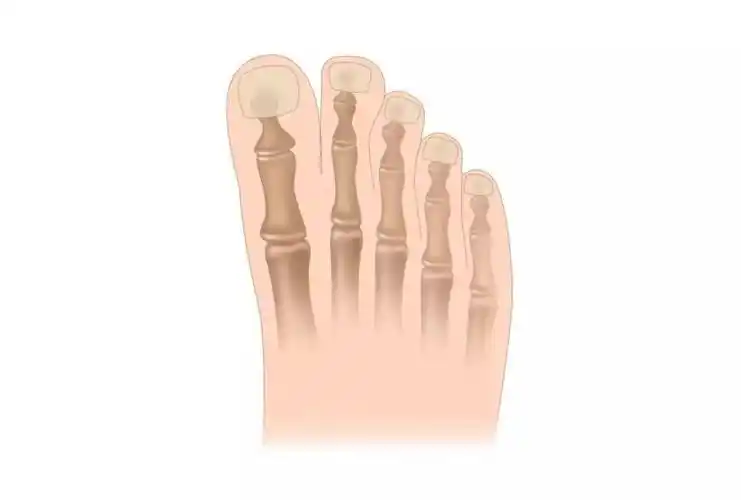 宜选择脚面有装饰,较扁平的鞋款,鞋头较宽,鞋腰稍窄,注意鞋底防滑.