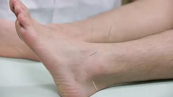 针灸疗法—外踝关节扭伤的治疗