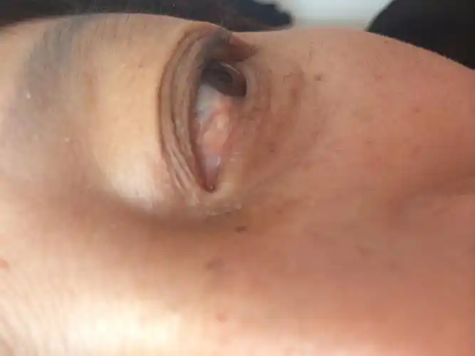 我眼睛长了个东西麻烦医生帮我看看要不要紧