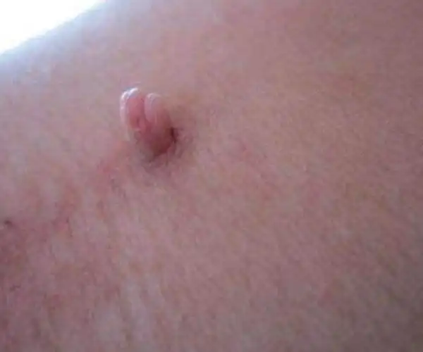 脖子和腋下的小肉粒是什么能直接用手揪掉吗赶紧来看看