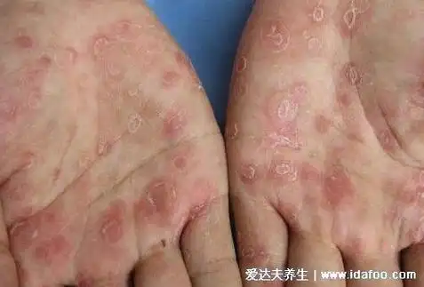 感染梅毒之后,大概7-60天会出现如图所示的硬下疳症状,是一期梅毒的