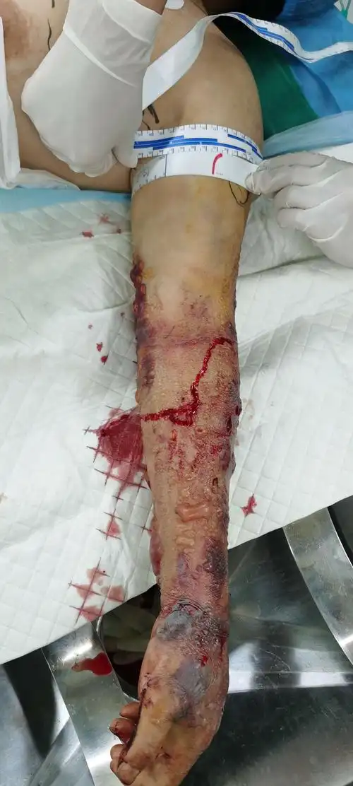 五步蛇咬伤重症,保命保肢,出院啦.