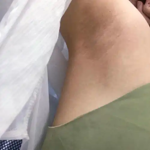 之前腋毛比较浓密,所以去做了激光脱毛,本来还担心去不干净的,做了一