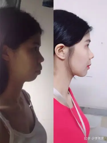 高龄骨性龅牙矫正成功告别生气脸