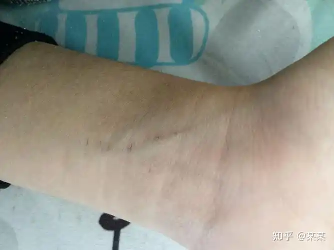 因为抑郁症割腕留下了疤痕,如何处理接下来的大学生活? - 知乎