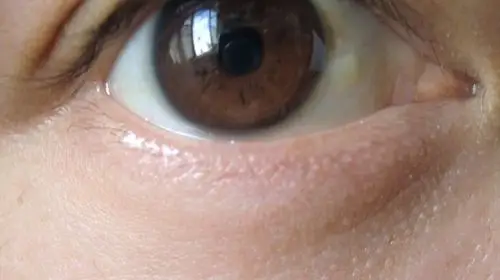 两只眼睛的白眼球都有黄色的东西是什么