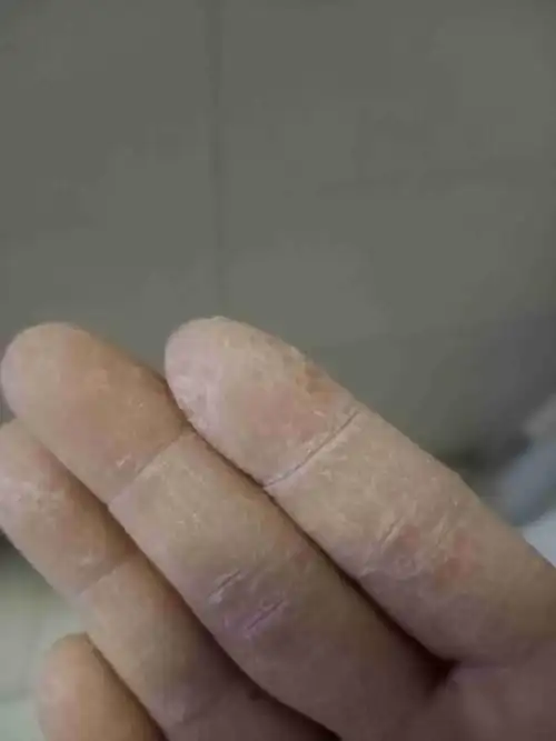 皲裂.一到冬天手和脚就开裂,怎么治,能治好吗?