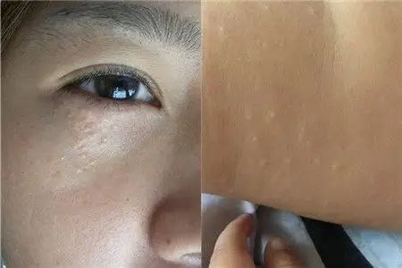 【图】如何去除脂肪粒 打造精致面容