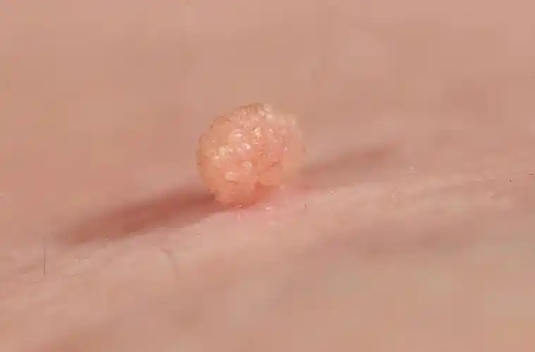 皮肤上的小肉球,小肉疙瘩是什么?7种可能,情况有好有坏