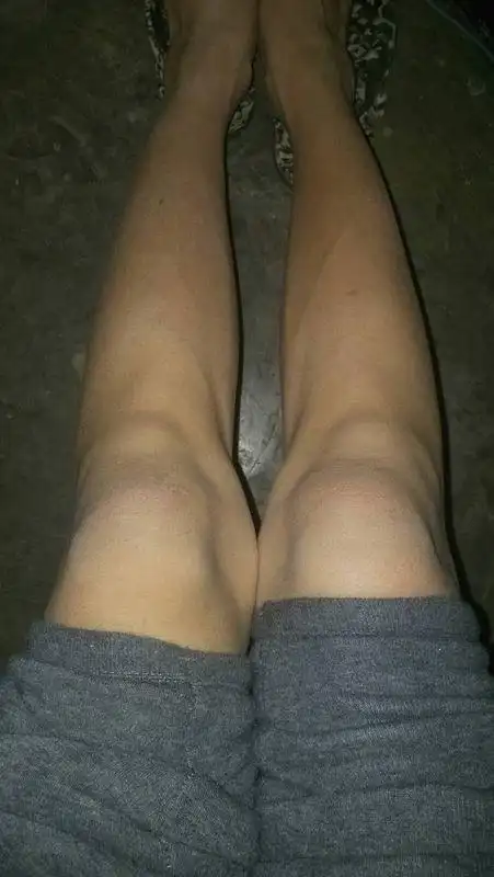 膝盖下面鼓起来的骨头一般不会疼蹲下去