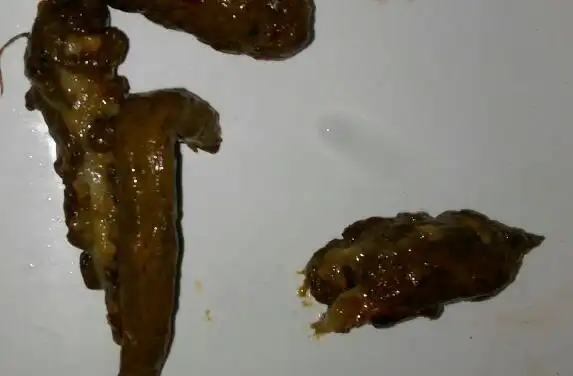 做过结肠息肉切除手术和混合痔手术,术后大便经常出现带脓的情况,不