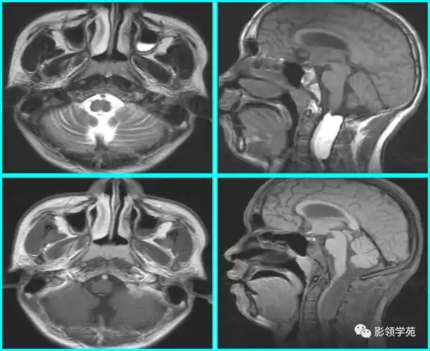 儿童腺样体肥大影像表现及诊断标准